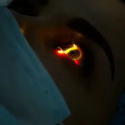 Lazer ile Astigmat Tedavisi