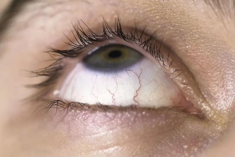 lazer göz ameliyatı sonrası göz kuruluğu olur mu